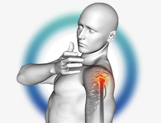 Ever heard about Shoulder Impingement Syndrome?